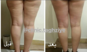 نمونه کاهش وزن با رژیم لاغری دکتر شیرین اباذری