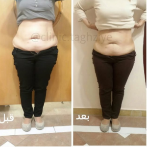 نمونه کاهش وزن با رژیم لاغری دکتر شیرین اباذری