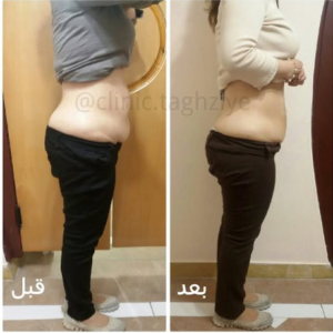 نمونه کاهش وزن با رژیم لاغری دکتر شیرین اباذری