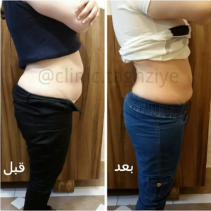 نمونه کاهش وزن با رژیم لاغری دکتر شیرین اباذری
