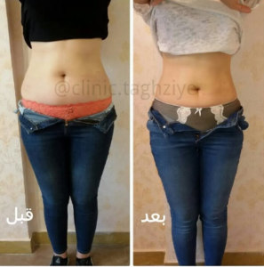 نمونه کاهش وزن با رژیم لاغری دکتر شیرین اباذری