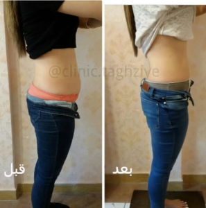 نمونه کاهش وزن با رژیم لاغری دکتر شیرین اباذری