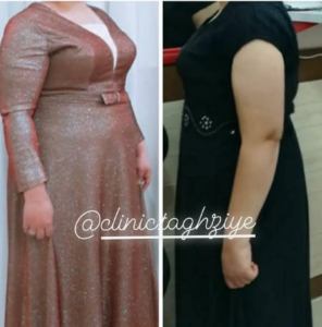 نمونه کاهش وزن با رژیم لاغری دکتر شیرین اباذری