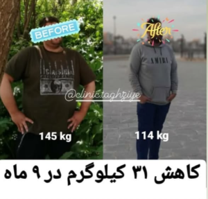 نمونه کاهش وزن با رژیم لاغری دکتر شیرین اباذری