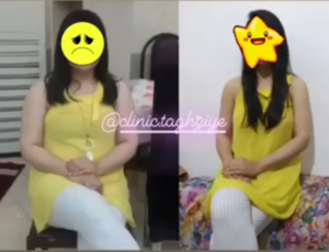 نمونه کاهش وزن با رژیم لاغری دکتر شیرین اباذری