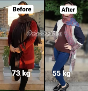 نمونه کاهش وزن با رژیم لاغری دکتر شیرین اباذری