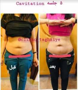 نمونه کاهش وزن با رژیم لاغری دکتر شیرین اباذری