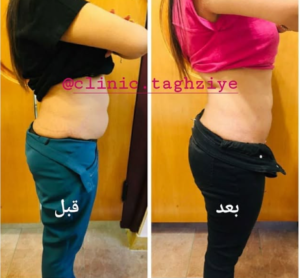 نمونه کاهش وزن با رژیم لاغری دکتر شیرین اباذری