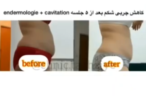 نمونه کاهش وزن با رژیم لاغری دکتر شیرین اباذری