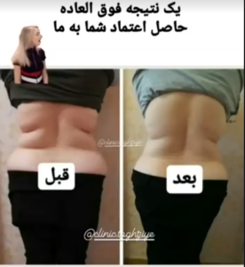 نمونه کاهش وزن با رژیم لاغری دکتر شیرین اباذری