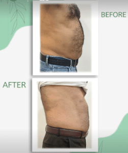 نمونه لاغری با رژیم و دستگاه دکتر سامره یعقوبیان