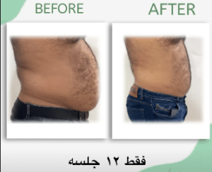 نمونه لاغری با رژیم و دستگاه دکتر سامره یعقوبیان